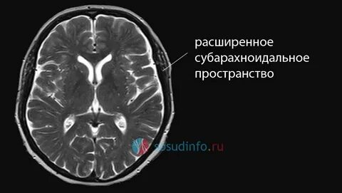 Умеренно расширены ликворные пространства