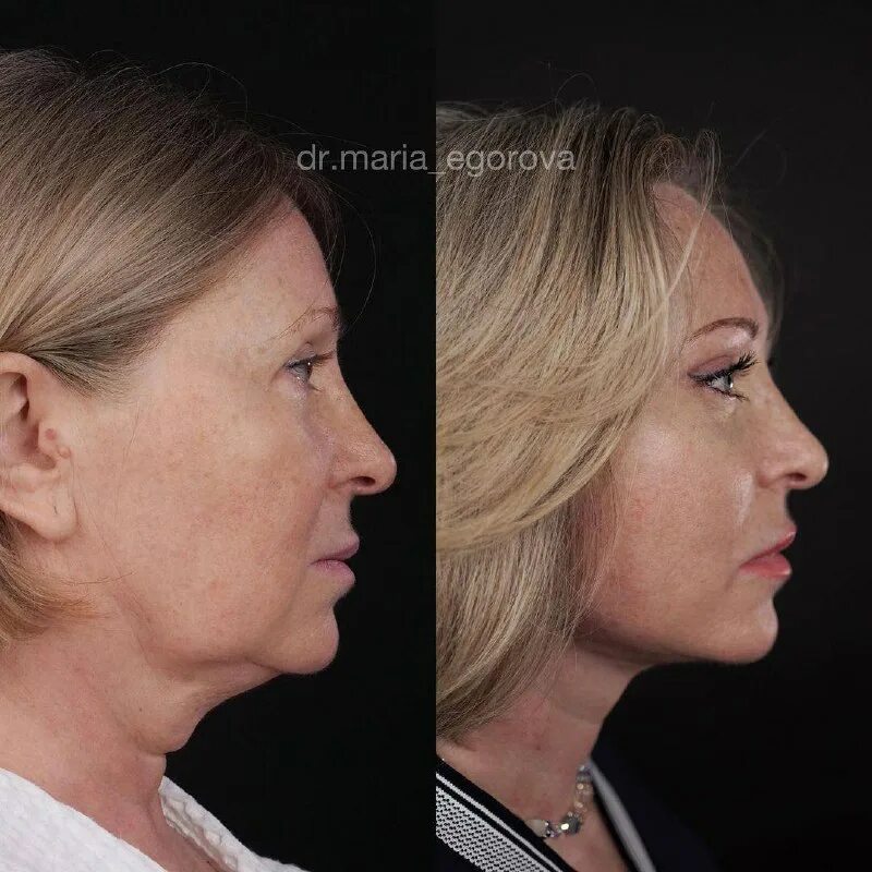 нижний эффект