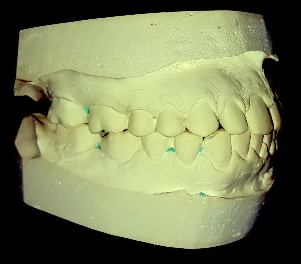 Изготовление гипсовой модели. Гипсовая модель зубов. Гипсовые модели челюстей. Диагностические гипсовые модели. Диагностические модели челюстей.