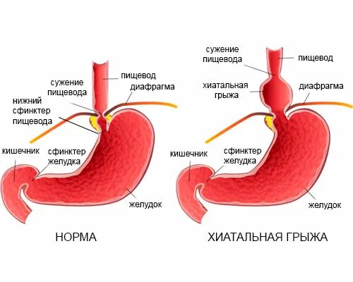 Пролапс желудка в пищевод. Скользящая грыжа пищеводного отверстия диафрагмы симптомы. Врожденная мембранная диафрагма пищевода. Аксиальная диафрагмальная грыжа. Хиатальная грыжа пищеводного отверстия диафрагмы.