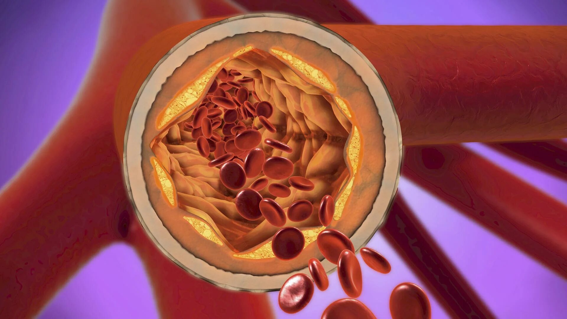 Кровь закупорка сосудов. Атеросклероз кровеносных сосудов. Холестериновые бляшки в сосудах. Сужение кровеносных сосудов. Кровяные бляшки в сосудах.