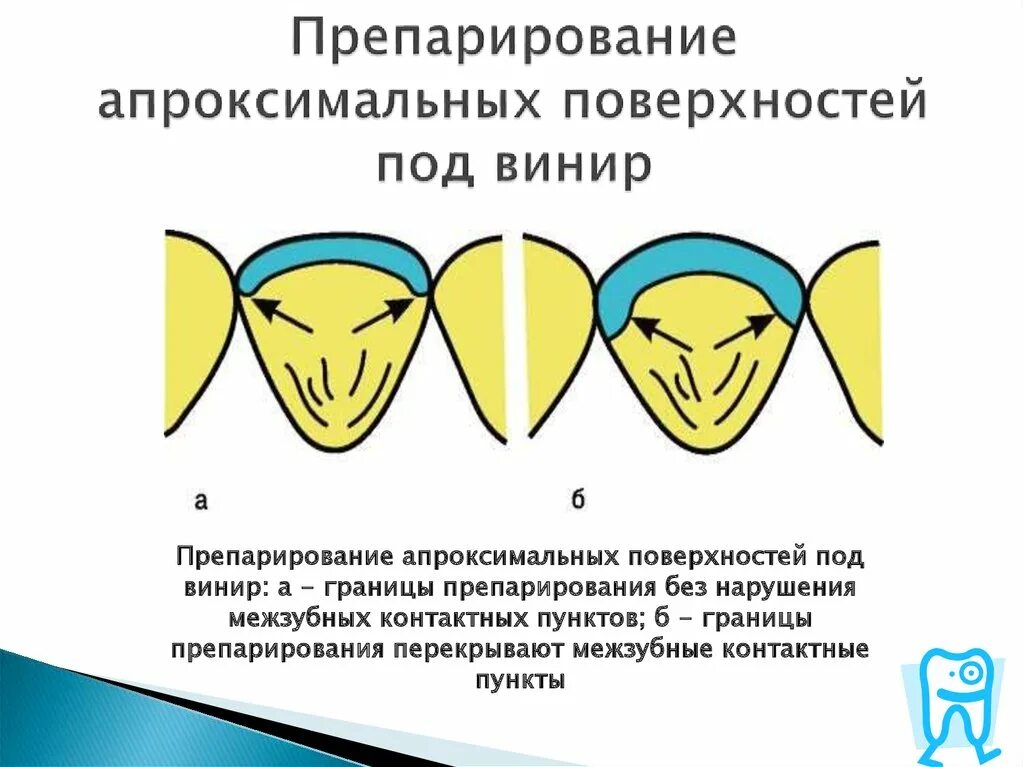 Препарирование это. Препарирование апроксимальных поверхностей зуба. апроксимальных контактных поверхностей. препарирование зубов под винир. методы препарирования под виниры.