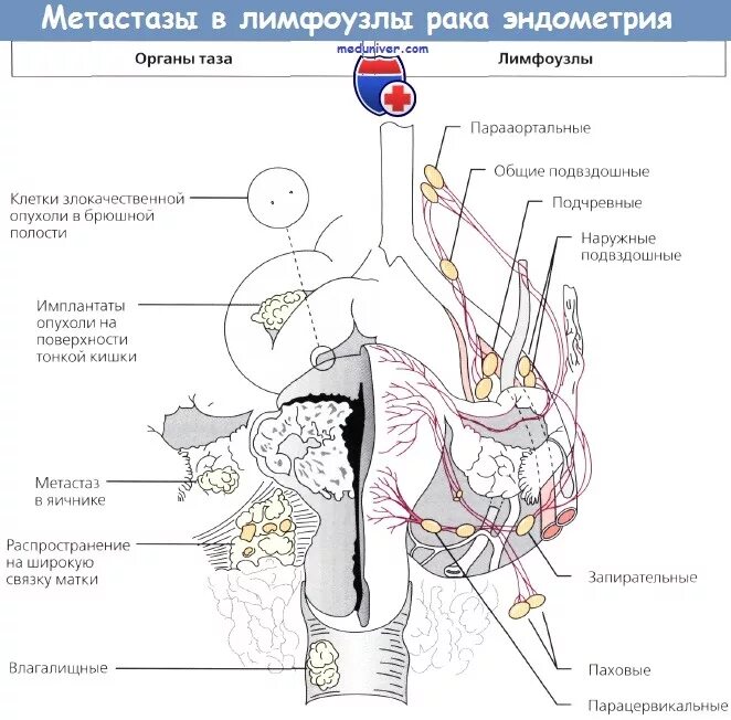 Метастазы лимфоузлы форум. Лимфоузлы малого таза анатомия. Подвздошные и парааортальные лимфоузлы. Лимфоузлы таза схема. Обтураторные лимфатические узлы.