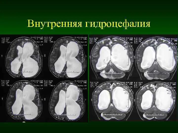 Заместительная наружная гидроцефалия кт. Внутренняя окклюзионная гидроцефалия мрт. Окклюзионная гидроцефалия кт. Окклюзионная гидроцефалия мрт.