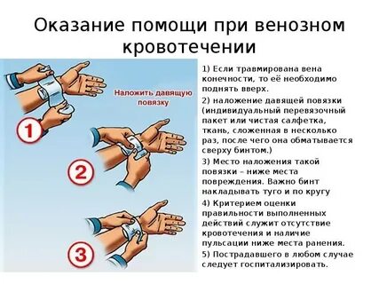 Способы временной остановки кровотечения давящей повязкой