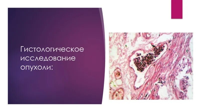 Ошибочная гистология. Нейробластома гистология. миофибробластическая опухоль гистология.