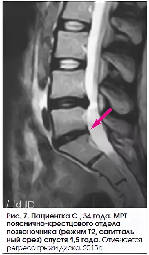 Листез позвонка мрт. Остеохондроз поясничного крестцового отдела на мрт. Межпозвонковые диски т1. Т2. Т1 и т2 мрт пояснично крестцового отдела.