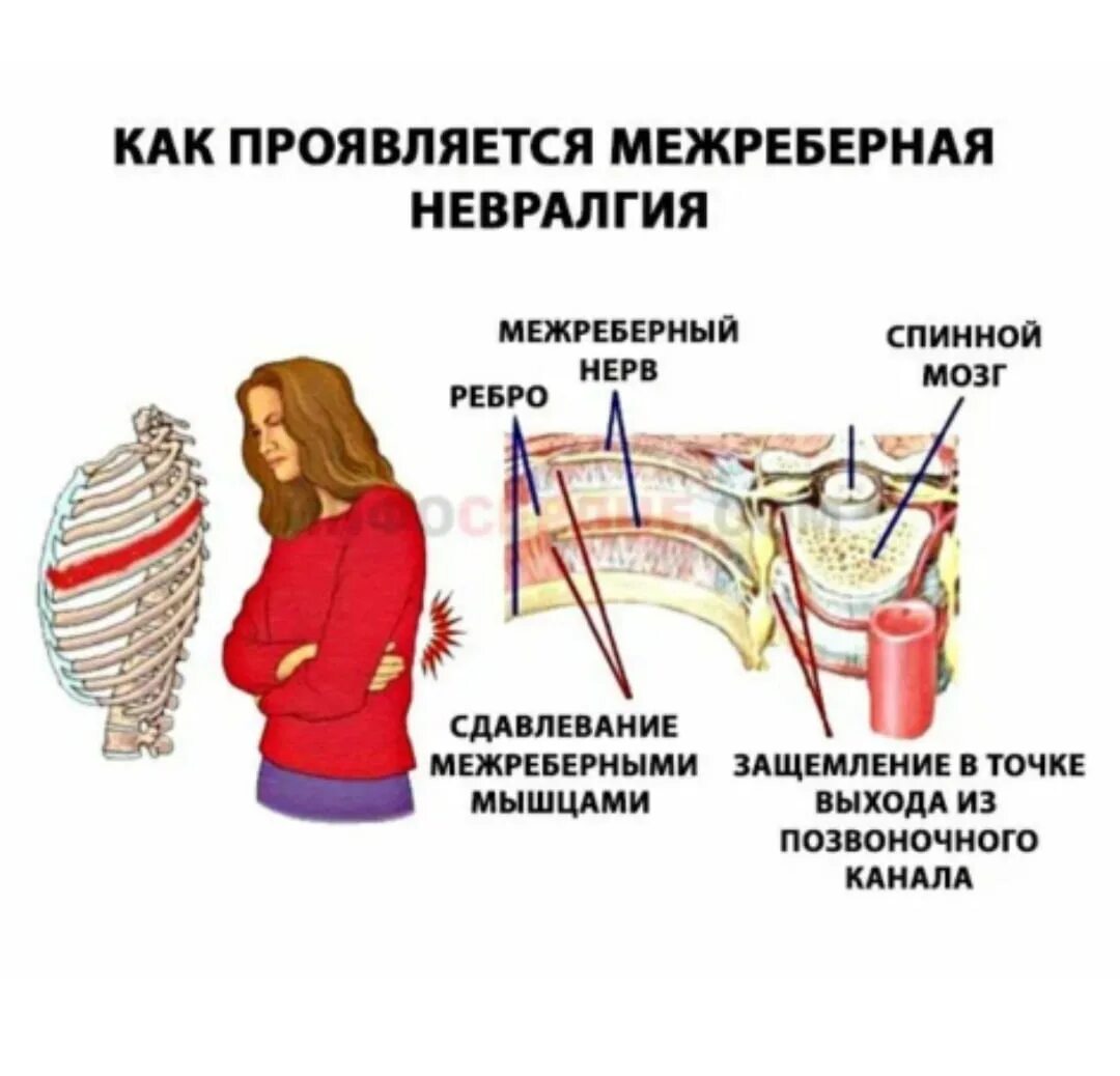 Межреберная невралгия причины симптомы. Неврология межреберная симптомы. Невралгия межреберная с левой стороны симптомы. Межреебернаяневролгия.