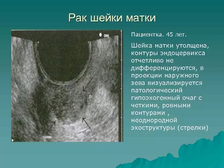 Рак 0 матки. Ультразвуковое исследование шейки матки при раке.. Рпкмшейки матки на УЗИ. Опухоль шейки матки на УЗИ. Патология шейки матки на УЗИ.