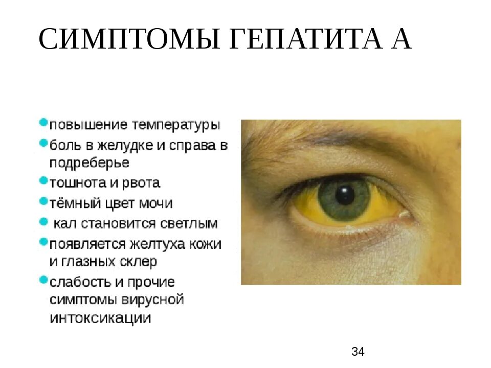 Желтуха заразная или нет. Основные клинические симптомы гепатита в. Основные клинические симптомы гепатита б. Симптомы гепатита желтухи. Клинические проявления гепатита а.