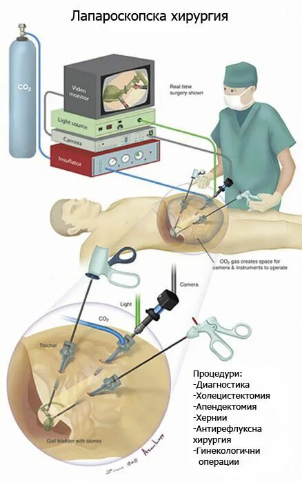 Лапароскопия показания. Лапароскопическая резекция опухоли почек. Лапароскопическая хирургия желчный пузырь. Лапароскопическая операция гидронефроз. Лапароскопические малоинвазивные операции.