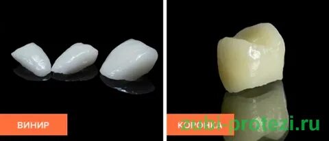 Разница между винирами и коронками