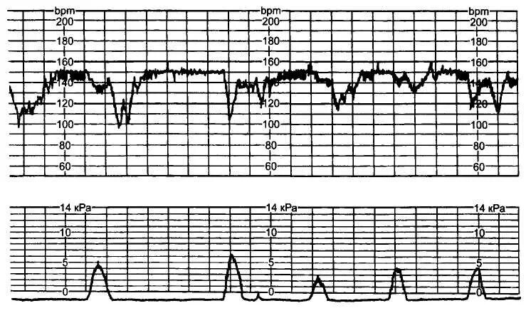 Исследование сердцебиения плода. Базальный ритм на КТГ. Кардиотокограмма норма. Патологический Тип Кривой КТГ. Патологический Тип КТГ плода.