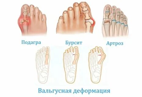 Болят пальцы на ногах и руках причины