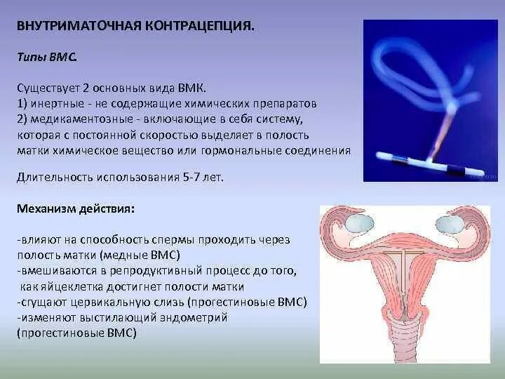 Внутриматочная спираль методы контрацептивов. Инертные внутриматочные контрацептивы. . Внутриматочные противозачаточные средства (спирали). Гормональная контрацепция ВМС Мирена.