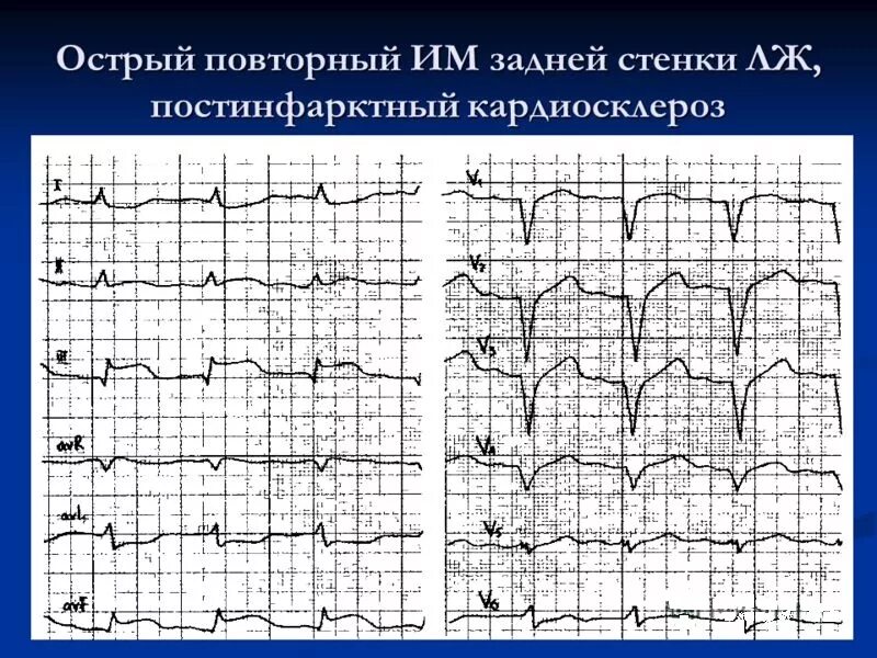 Изменение передней стенки левого желудочка. Признаки заднего инфаркта миокарда на ЭКГ. Инфаркт миокарда задней стенки на ЭКГ. ЭКГ ИБС постинфарктный кардиосклероз. ЭКГ при ИБС: постинфарктный кардиосклероз.