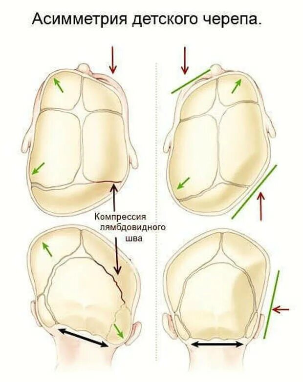 Деформация кости черепа. Асимметрия формы черепа. Асимметричная форма черепа. Асимметрия детского черепа. Форма черепа у новорожденного.