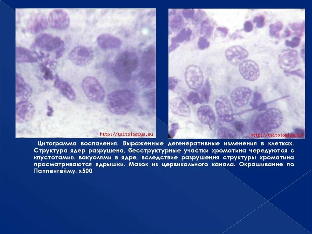 Воспаление с реактивными изменениями клеток. Цитограмма воспаления. Цитограмма выраженного воспаления. Воспаление цитограммы что это. Цитограмма умеренного воспаления что это.