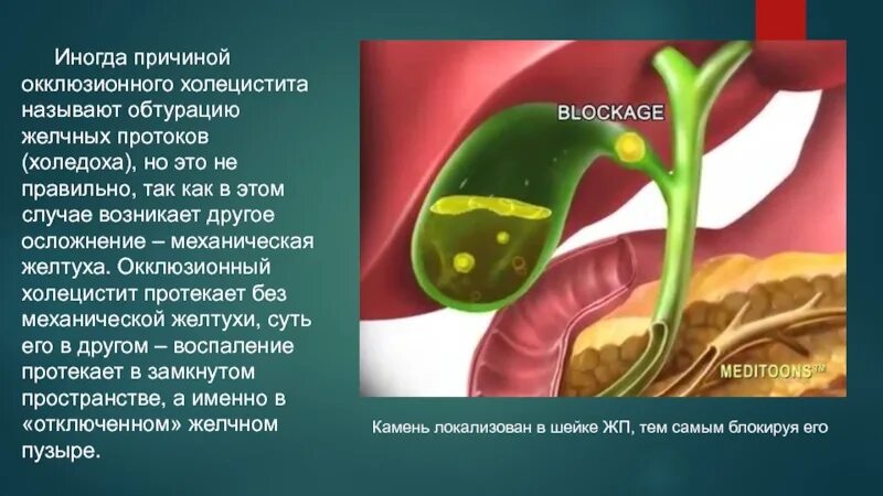 Окклюзионный (обтурационный) холецистит. Холецистит желчного пузыря. Хронический холецистит презентация. Берг желчный