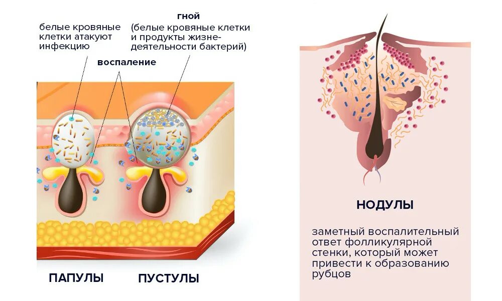 Лицо после акне: Как появляются рубцы от прыщей на лице и почему лазерная шлифов