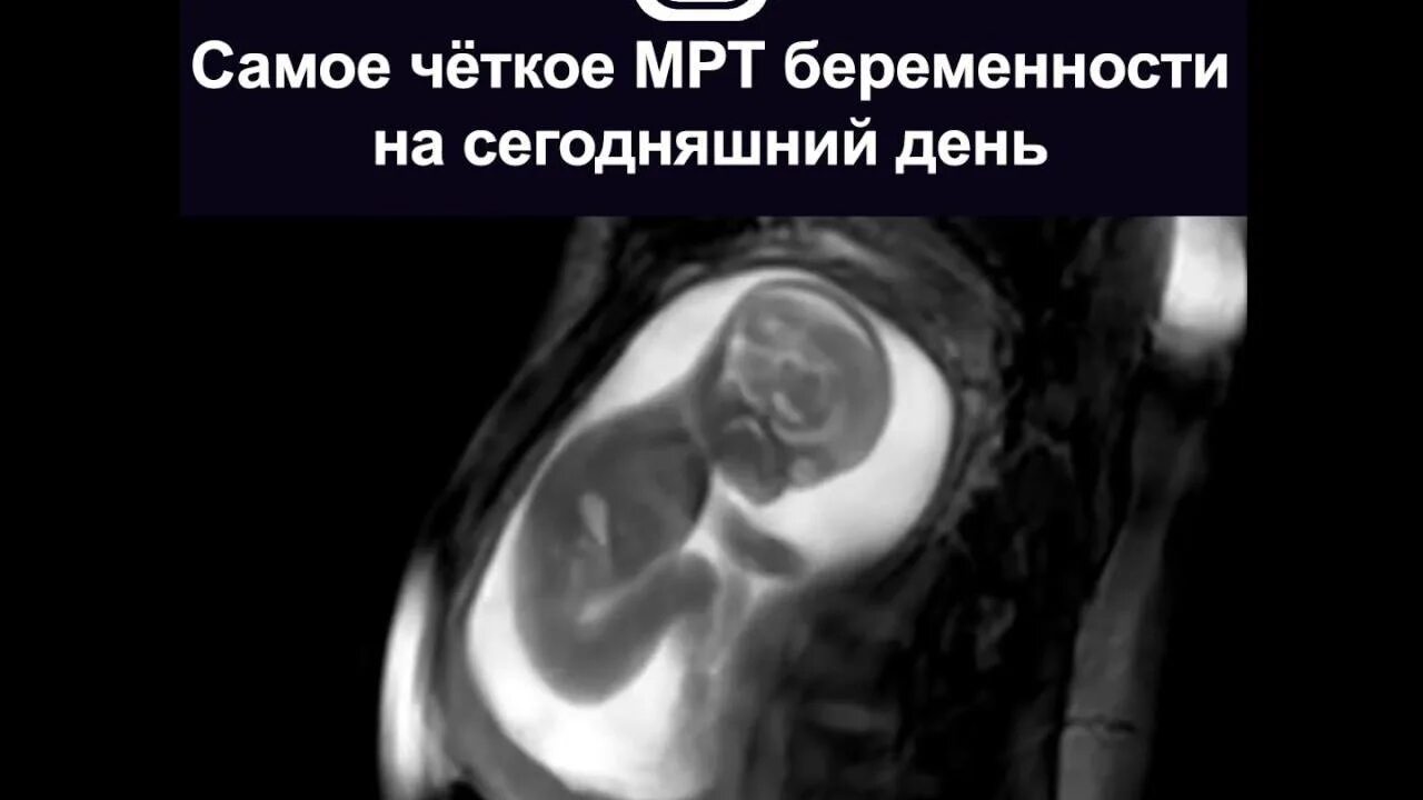 Мрт беременной. Мрт беременной
