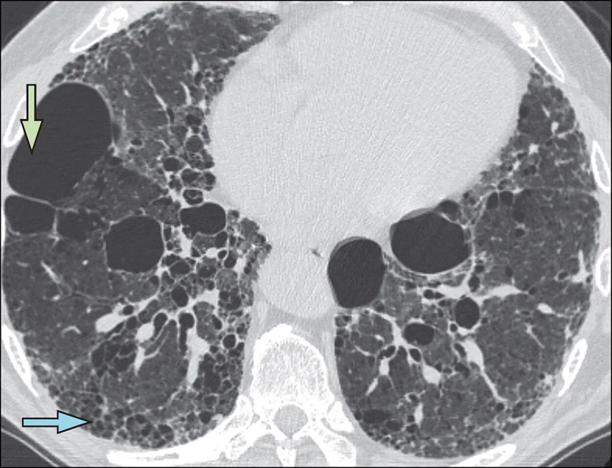 Идиопатический легочный фиброз кт. Идиопатичесаая интерстицианльнвя пневлсния кт. Идиопатический фиброз лёгких на кт. Интерстициальная эмфизема на кт.