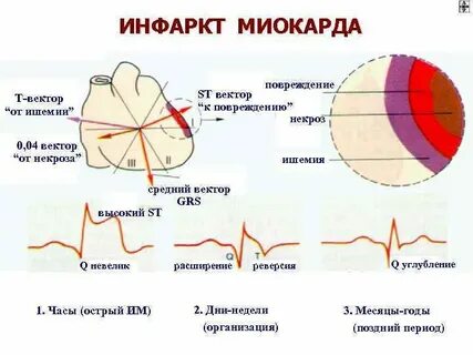 Отличие инфаркта