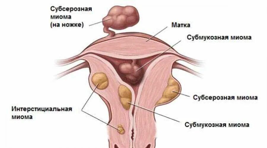 Эко при миоме матки. Лейомиома мочевого пузыря. субсерозный узел матки. фибромиома подслизистая.