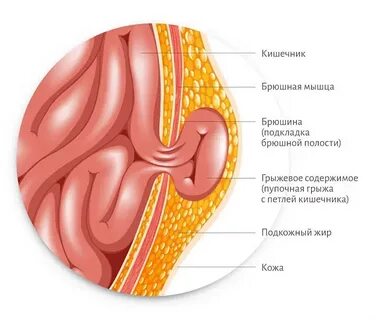 Можно жить с грыжей