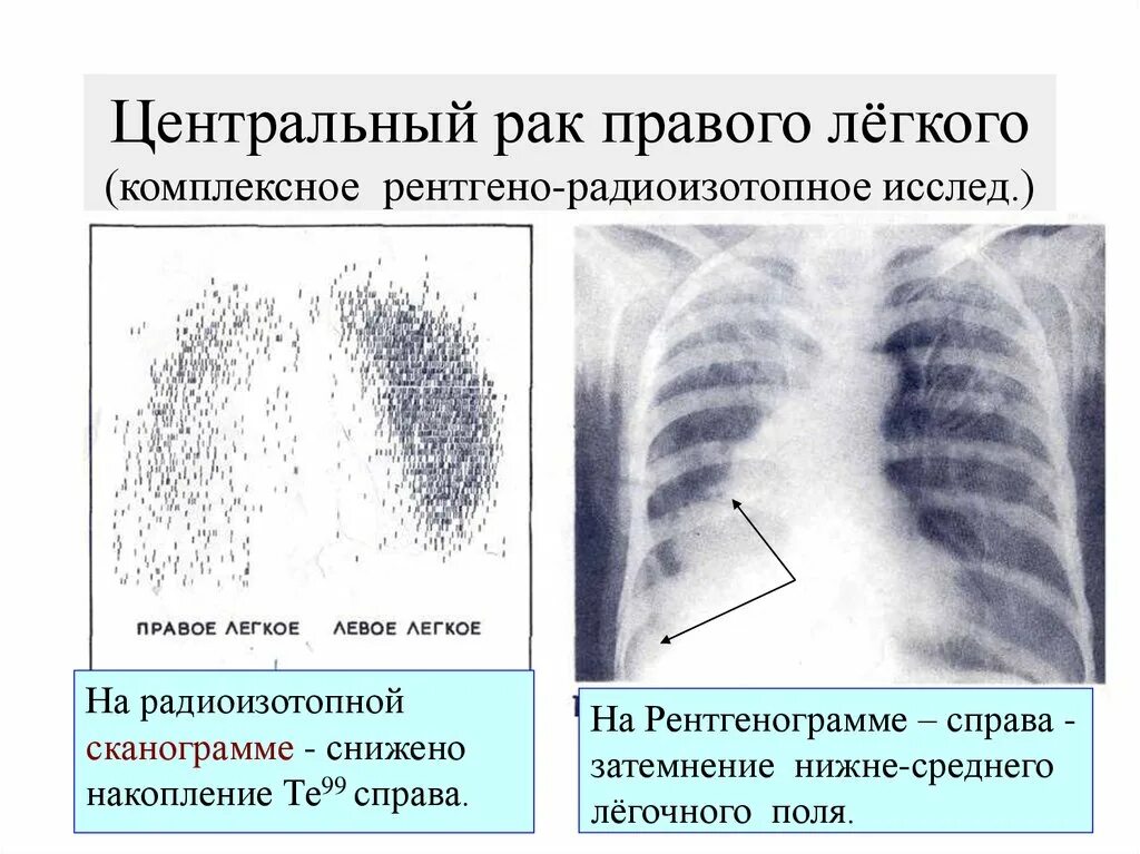 Рак центрального правого