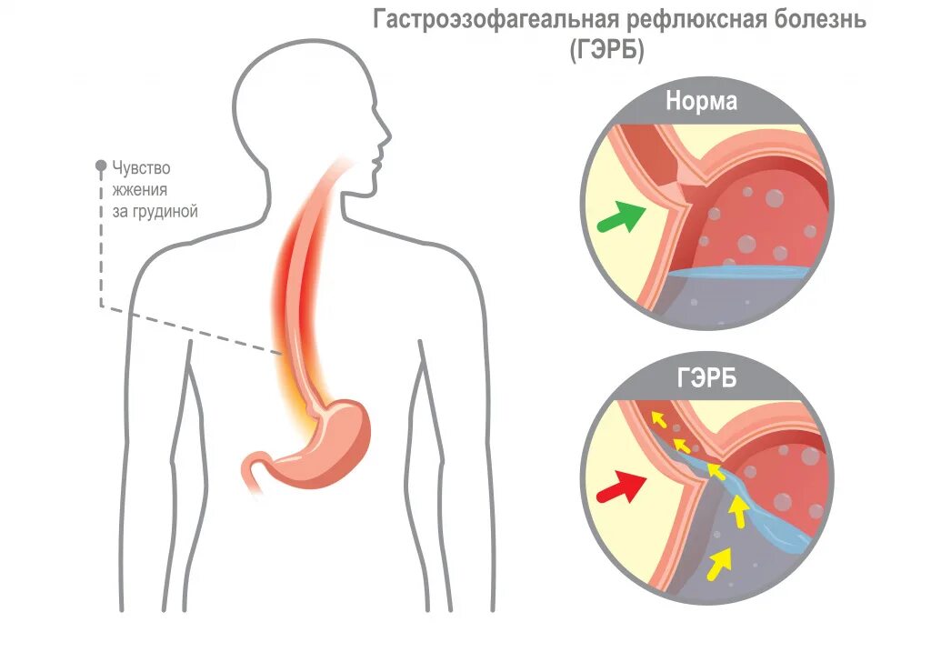 Изжога причины. Рефлюксная болезнь картинки. Почему бывает жжение