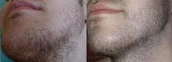 Рост волос на лице у мужчин. Миноксидил алерана. Алерана миноксидил для бороды. Миноксидил для волос для мужчин для бороды. Миноксидил Генеролон для бороды.