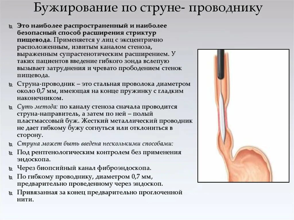 Методика бужирования пищевода. Бужирование пищевода у детей техника. Антеградное бужирование пищевода. Стеноз пищевода бужирование. Пищевод отзывы