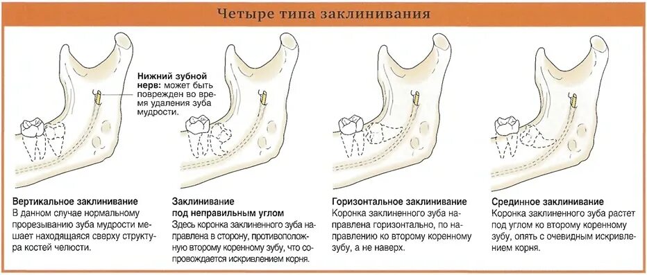 тройничный нерв в нижней челюсти рентген. если в зубе мудрости нерв. удаление зуба мудрости лицевой нерв. в зубах мудрости есть нервы. удаление зуба мудрости лицевой нерв.
