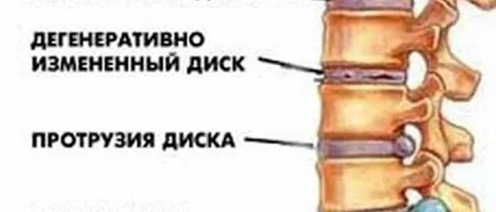 Протрузии дисков позвоночника поясничного и шейного отдела. Грыжа диска и протрузия диска. Протрузия дисков позвоночника рисунок. Схема операция при протрузии поясничного отдела позвоночника. Протрузия грыжа межпозвонковых дисков.