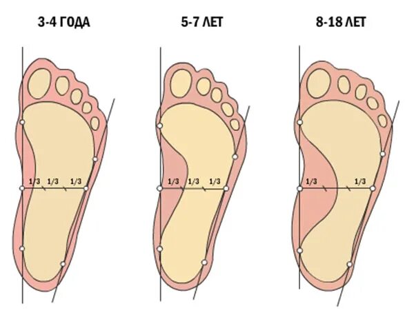 Средняя стопа. Свод стопы у ребенка 5 лет. Сводчатая стопа и плоскостопие. Плоскостопие 2 степени у ребенка 2 года. Плоскостопие у ребенка 6 лет.