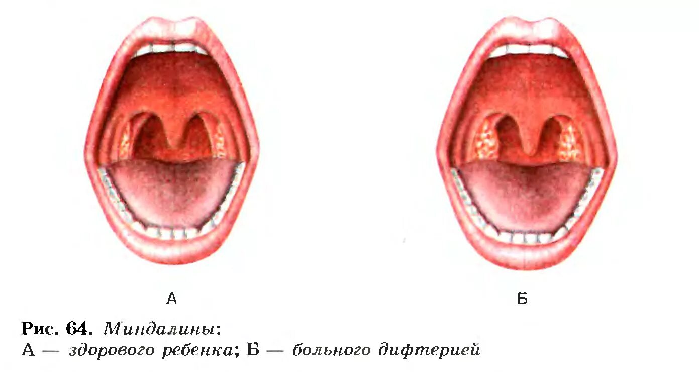 Зев красный. Дифтерия ротоглотки островчатая. Гиперемия слизистой зева.