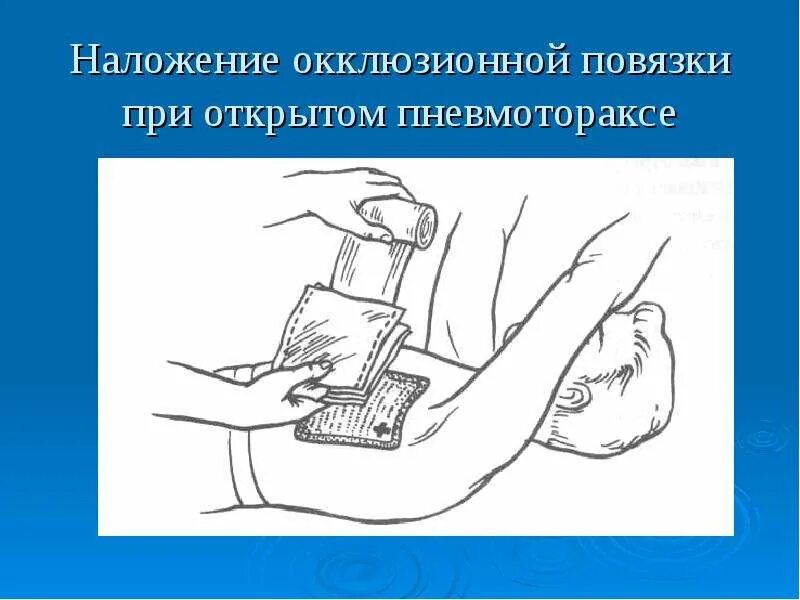 Техника наложения окклюзионной