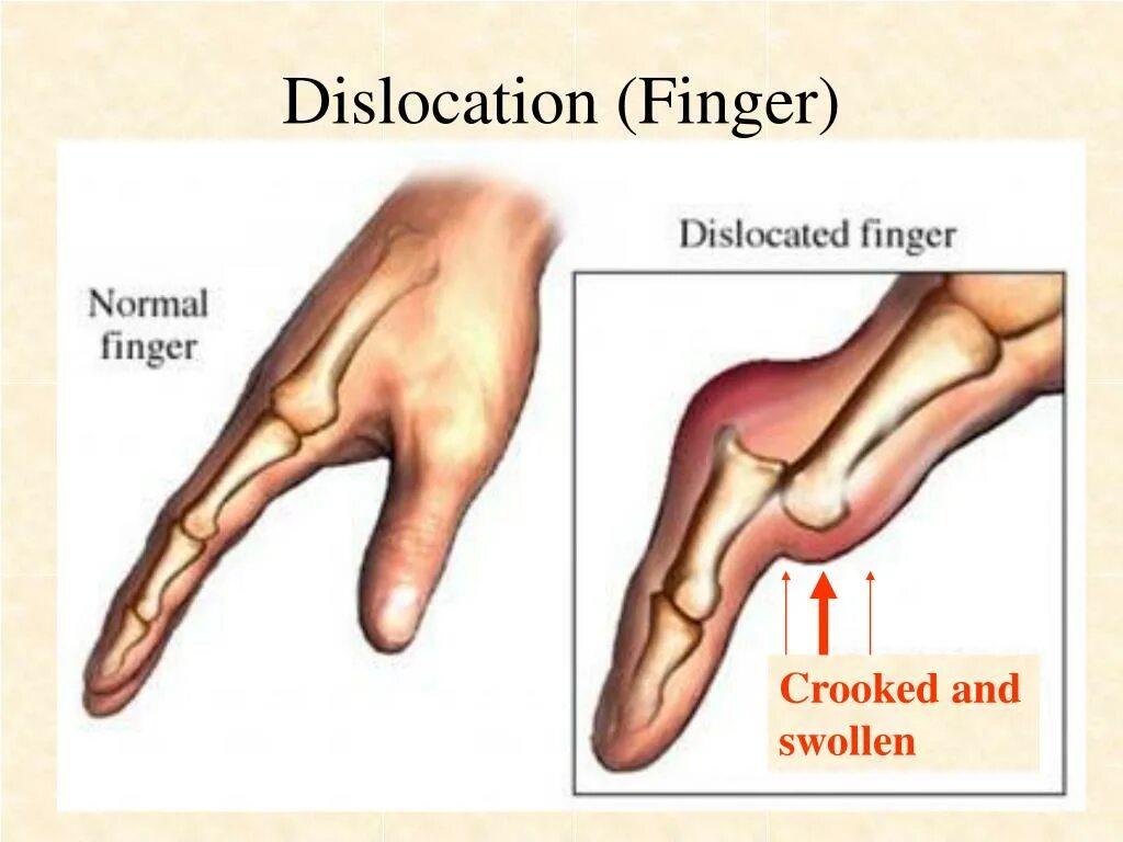 фиксирующая гипсовая повязка. вывихнул большой палец на руке. растяжение сустава пальца. вывих пястно-фалангового сустава. подтаранный вывих стопы.
