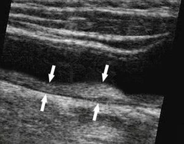 Подколенная Вена тромбоз УЗИ. Тромбоз подколенной вены на УЗИ. Тромбоз сонной артерии УЗИ. Тромбоз артерий нижних конечностей на УЗИ. Тромб и бляшка разница