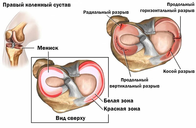 Разрыв мениска коленного сустава. Строение внутреннего мениска коленного сустава. Обрыв мениска коленного сустава. Разрыв мениска коленного сустава симптомы.