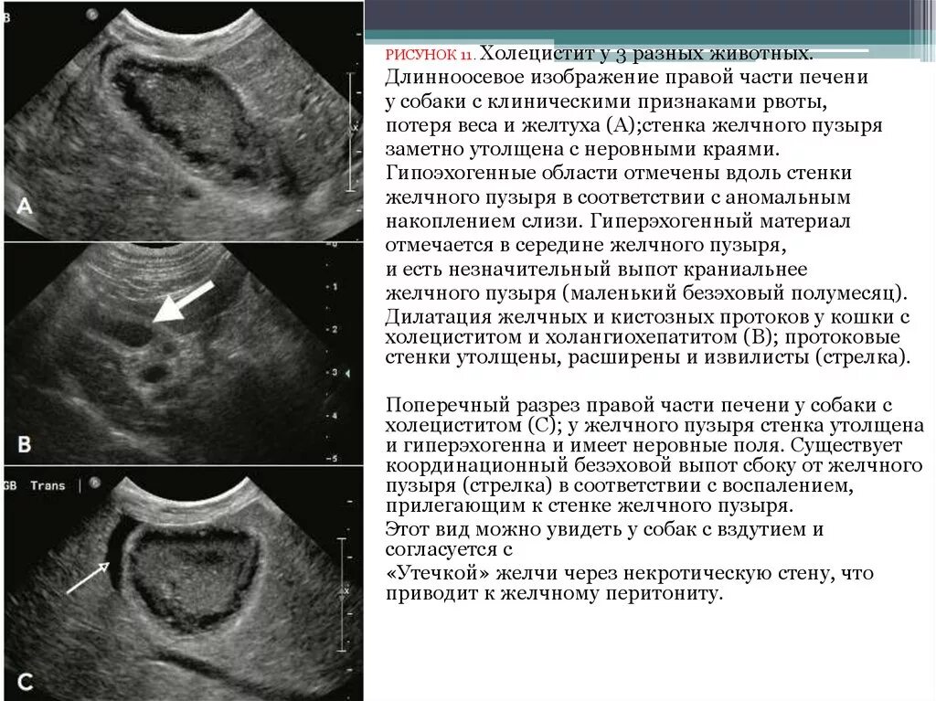 Сморщенный желчный пузырь. Утолщение стенки желчного пузыря на УЗИ. УЗИ желчного пузыря острый холецистит. Патология желчного пузыря на УЗИ. УЗИ желчного пузыря холецистит.