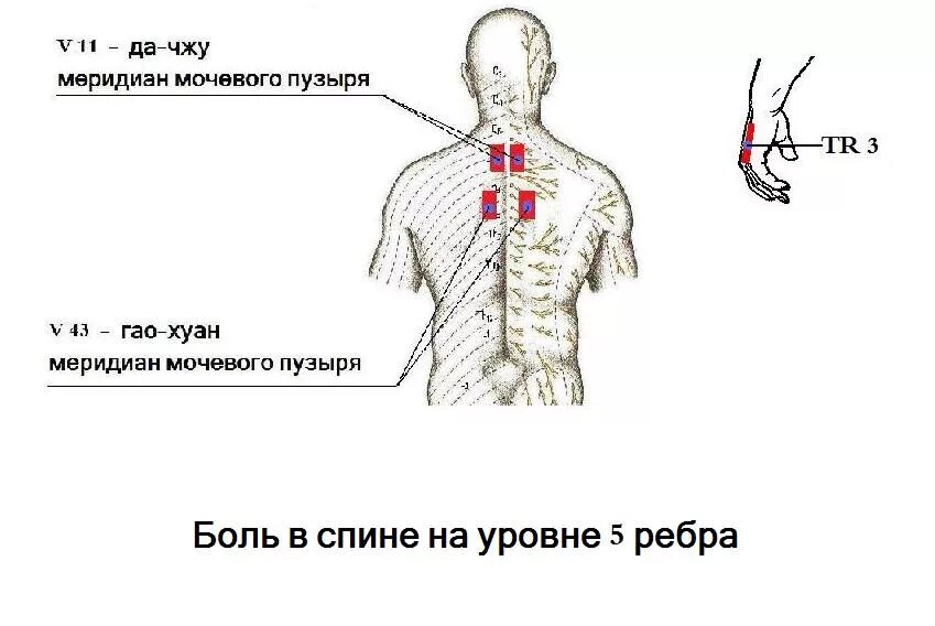 Схема боли в спине. Локализация боли в спине. Меридиан мочевого пузыря. Локализация болей в спине схема.