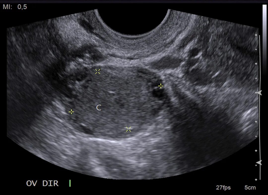 Киста o rads. Текома фиброма УЗИ. Опухоль Бреннера яичника.