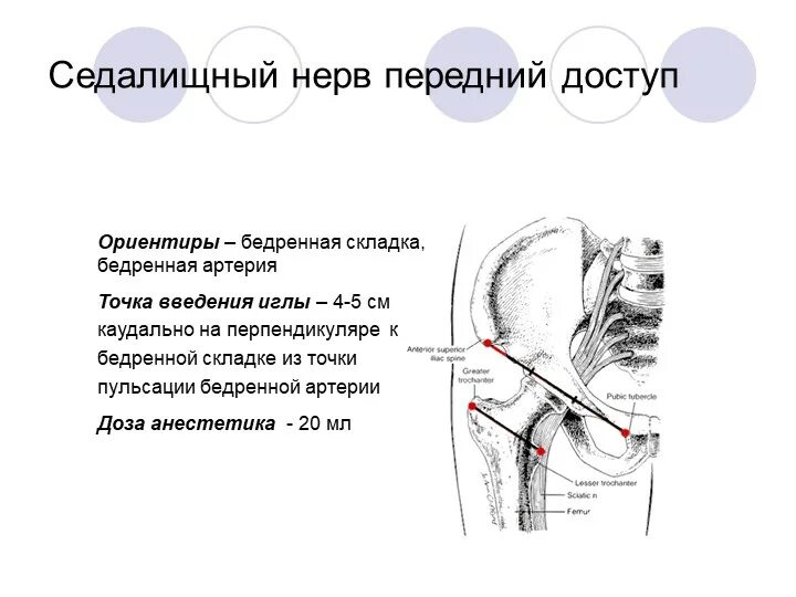 Блокада при защемлении седалищного нерва. Проводниковая анестезия седалищного нерва. Блокада бедренного, седалищного и запирательного нервов. Проводниковая анестезия бедренного и седалищного нервов. Блокада седалищного нерва анестезия.