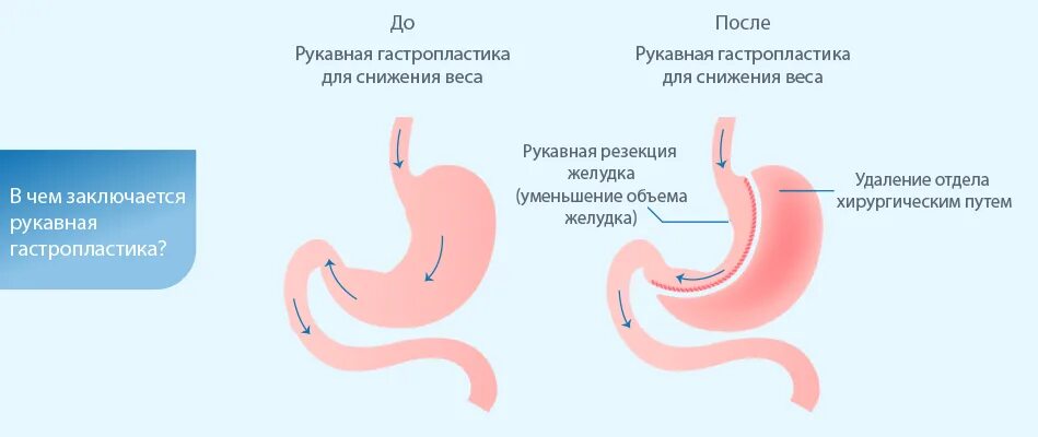 Вертикальная рукавная гастропластика. Бариатрия резекция рукавная желудка. Продольная (вертикальная, рукавная) резекция желудка.