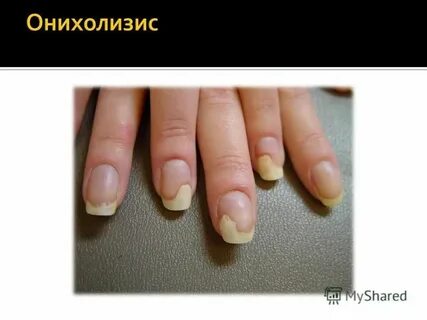 Чем лечить онихолизис ногтей отзывы