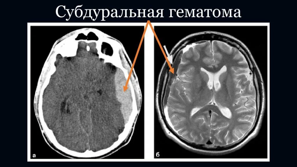 Острая субдуральная гематома кт. Суарахноидальное кровизлияниект. Субарахноидальное кровоизлияние кт картина. Травматическое субарахноидальное кровоизлияние кт. Травматическое кровоизлияние