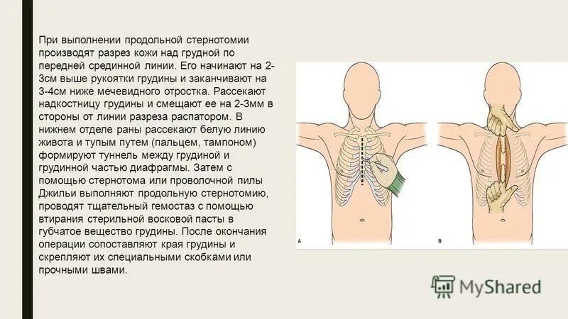 Срединная продольная стернотомия. Стернотомия грудной клетки что это. При продольной стернотомии. Срединная стернотомия разрез. Боли грудной клетки после операции