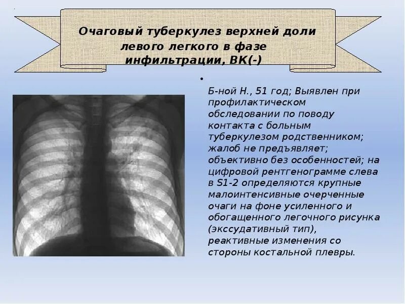 Фазы очагового туберкулеза